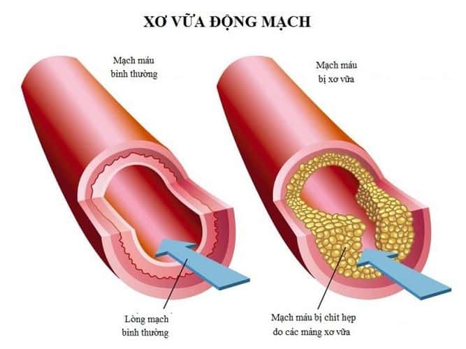 Trà Lá Sen Chống Sơ Vữa Động Mạnh Chống Sơ Vữa Động Mạnh