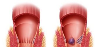 Bệnh Trĩ | Nguyên Nhân & Cách Điều Trị ? benh tri