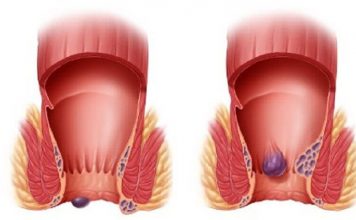 Bệnh Trĩ | Nguyên Nhân & Cách Điều Trị ? benh tri
