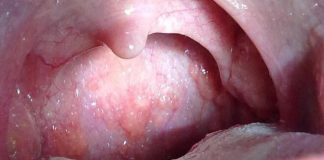 Những điều cần biết về ung thư vòm họng ung thu vom hong