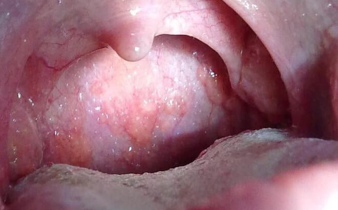 Ung thư vòm họng