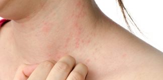 Eczema | Cách chữa bệnh chàm khỏi vĩnh viễn eczema