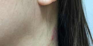 Bệnh Viêm Da Cơ Địa – Nhận Biết & Nguyên Nhân ? benh viem da co dia