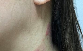 Bệnh Viêm Da Cơ Địa – Nhận Biết & Nguyên Nhân ? benh viem da co dia