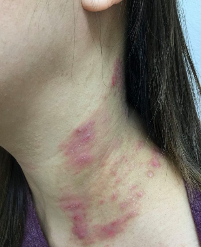 benh viem da co dia benh viem da co dia