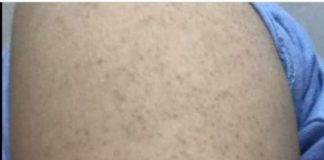 Dày sừng nang lông căn bệnh về da phổ biến mà khó chữa ?!