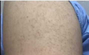 Dày sừng nang lông căn bệnh về da phổ biến mà khó chữa ?!