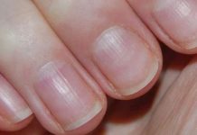 Dấu hiệu móng tay bất thường cảnh báo bệnh